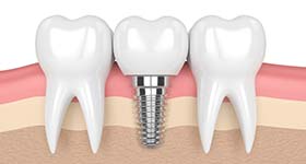 dental implants in miranda