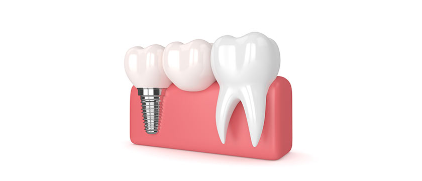 best-dental-implant-miranda